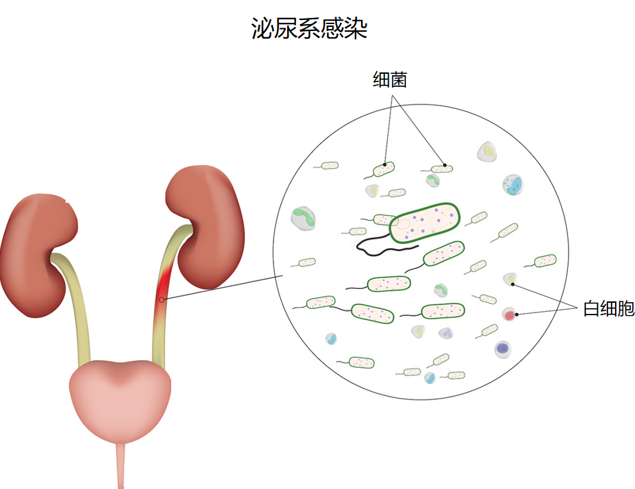 三伏天尿路結石的“高發季”，有(yǒu)哪些常見誤區(qū)