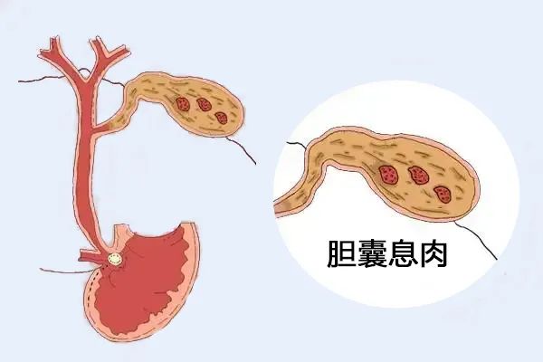 體(tǐ)檢出膽囊息肉，需要擔心嗎？