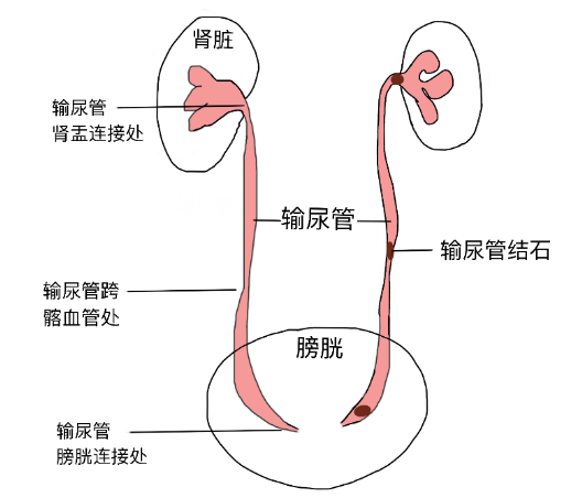 結石引發劇烈腎絞痛，該怎麽辦(bàn)？