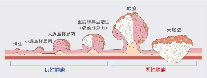 什麽樣的腸息肉容易癌變？有(yǒu)一種要特别當心！