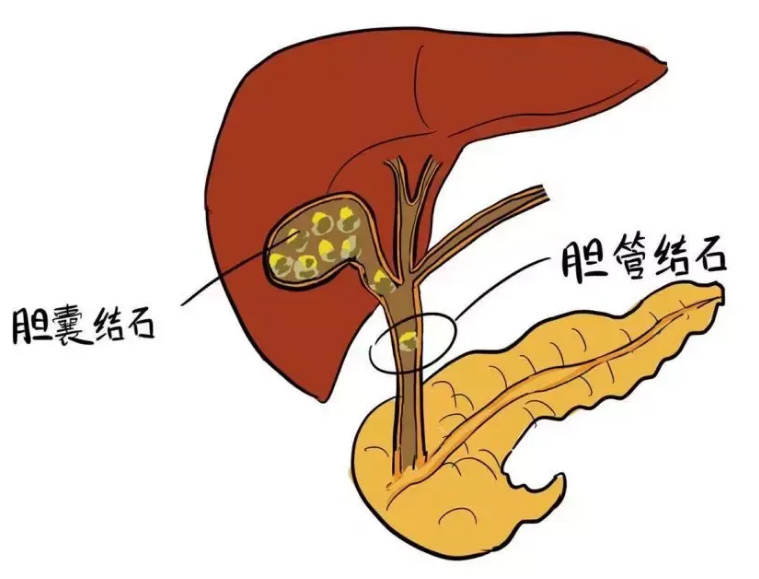 為(wèi)啥膽結石容易在一家人中(zhōng)“紮堆”？