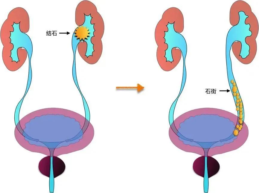 你經曆過腎絞痛嗎？該如何緩解治療？